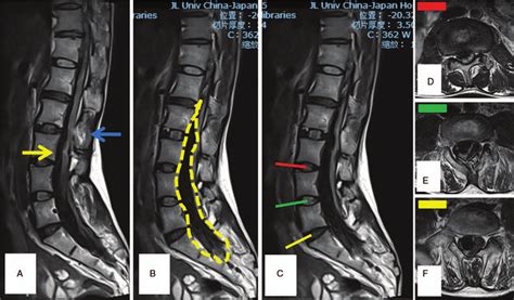 A The Sagittal T2 Weighted Image T2wi Magnetice Resonance Imaging