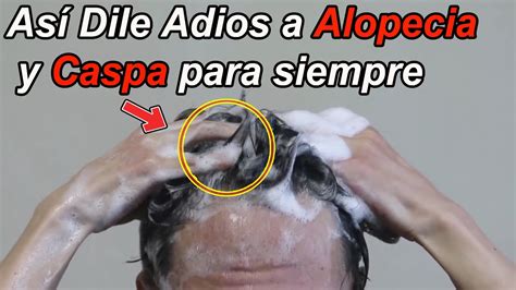 Dile Adi S A Calvicie Y Caspa Para Siempre F Cil De Curar Alopecia Y