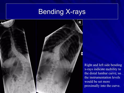 Case Review 12 14 Year Old Female With Adolescent Idiopathic