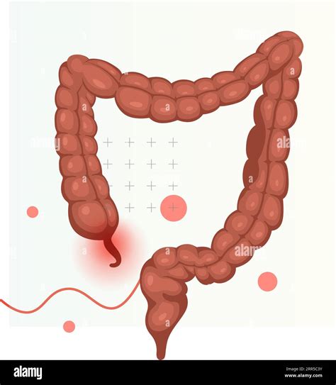 Appendicitis Inflamed Appendix Stock Illustration As Eps 10 File