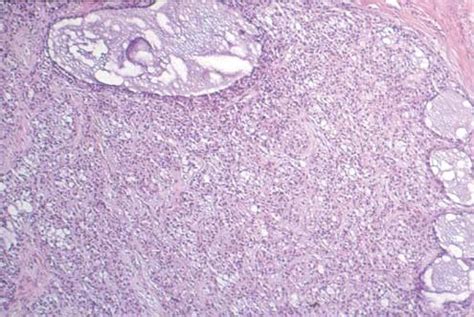 Sex Cord Stromal Tumors Of The Ovary And Testis Their Similarities And