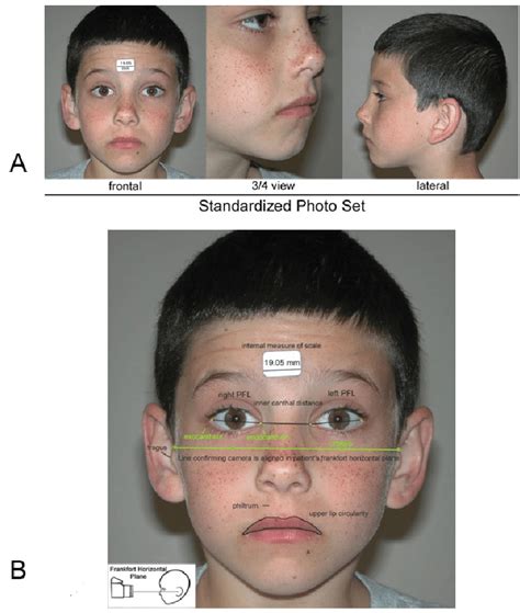 Fetal Alcohol Spectrum Disorder Facial Features Telegraph