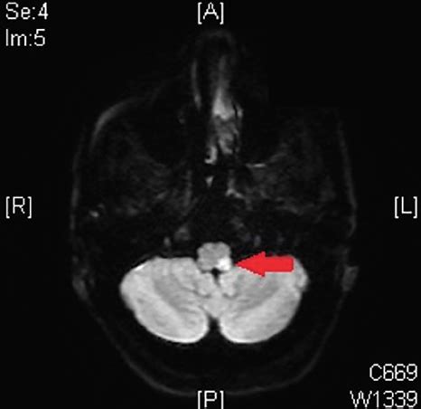 Lateral Pontine Syndrome Mri