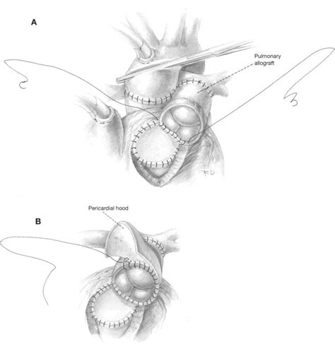 Repair Of Truncus Arteriosus Operative Techniques In Thoracic And