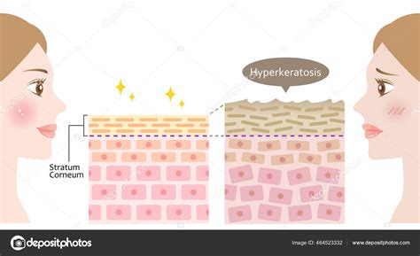 Diagram Thickening Stratum Corneum Woman Face Illustration Skin Care