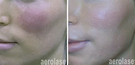 Rosacea My Perfect Skin Clinic