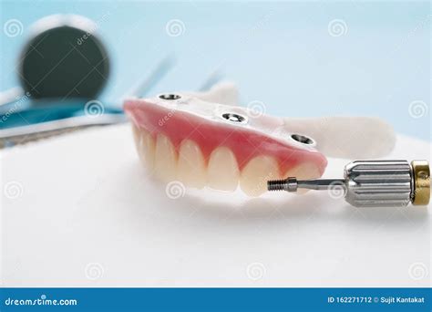 Dental Implants Supported Overdenture. Stock Photo - Image of dentist ...