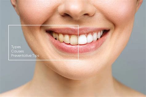 Tooth Discoloration Types Causes Preventative Tips And How To Remove