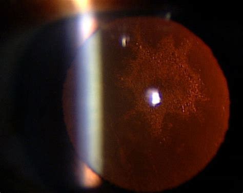 Posterior Subcapsular Cataract