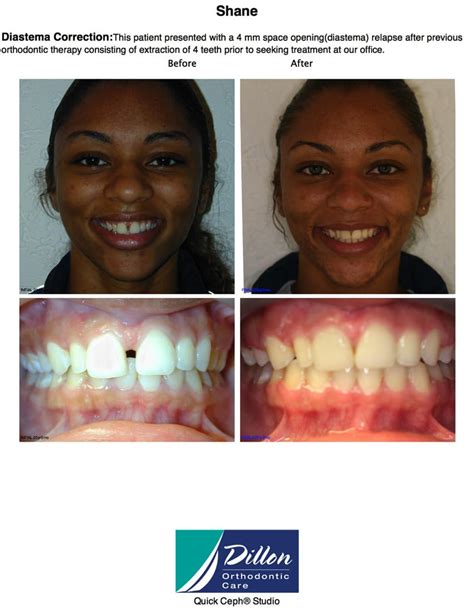 Gallery Invisalign Near Me Dillon Orthodontic Care