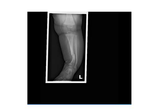 The case of the 'not-so-simple' fracture - BMJ Case Reports blog