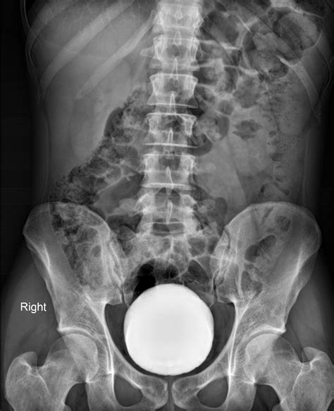 Urethral Stricture Image Radiopaedia Org