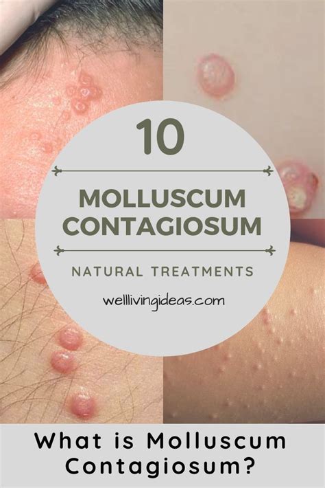 Using Apple Cider Vinegar On Molluscum Contagiosum