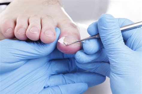 Ingrown Toenail Treatments Foot Doctor San Antonio Tx