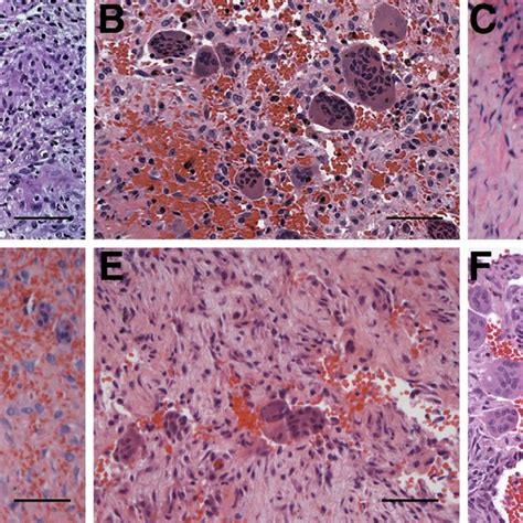 Multinucleated Giant Cells In Pathologic Lesions Hematoxylin And Eosin