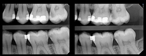 Detect Interproximal Caries Flashcards | Quizlet