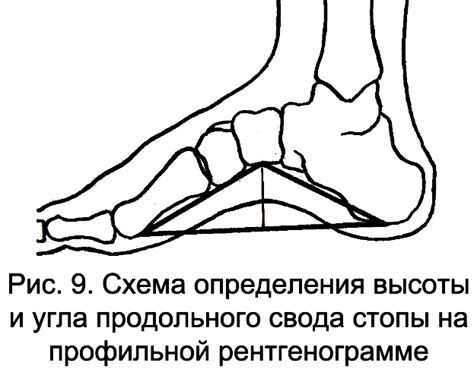 Продольное плоскостопие