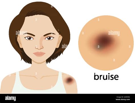 Woman With Bruise On Skin Illustration Stock Vector Image Art Alamy