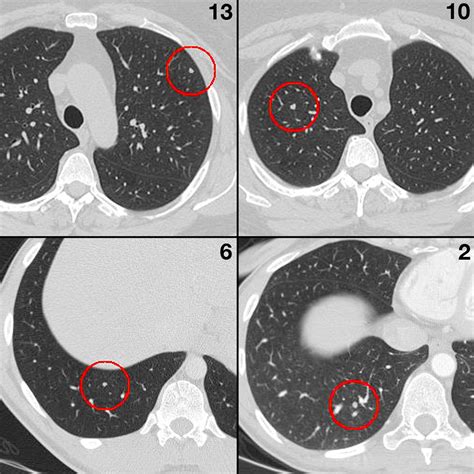 Characterizing Search Recognition And Decision In The Detection Of Lung Nodules On Ct Scans