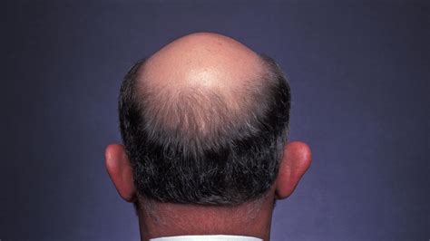 Is There A New Cure For Baldness What Is Osteoporosis Drug Way