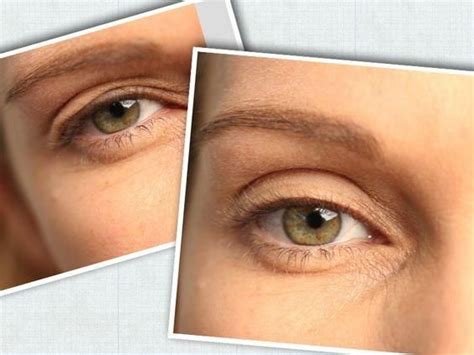 Eyelid Lift Without Surgery Eyelid Lift Cosmetic Surgery Droopy Eyelids