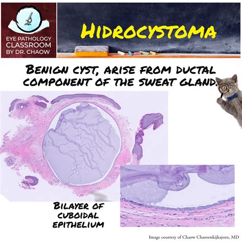 Eye Pathology Its Hidrocystoma Kiko Xp