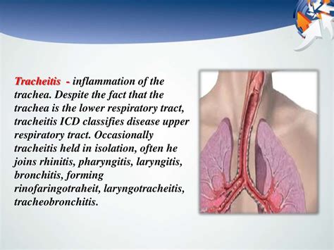 Tracheitis презентация онлайн