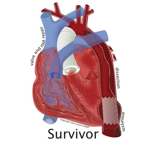 Marfan Syndrome Aortic Dissection