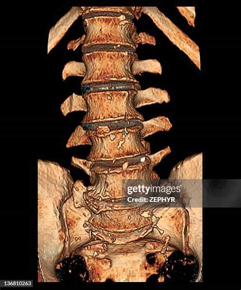 Degenerative Disc Disease Photos And Premium High Res Pictures Getty