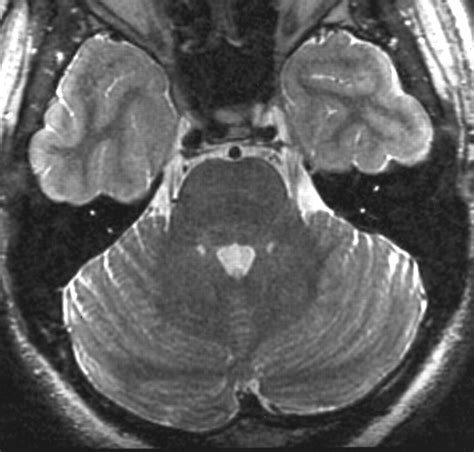 Modified Four Coil Phased Array Assembly For High Resolution Mr Imaging