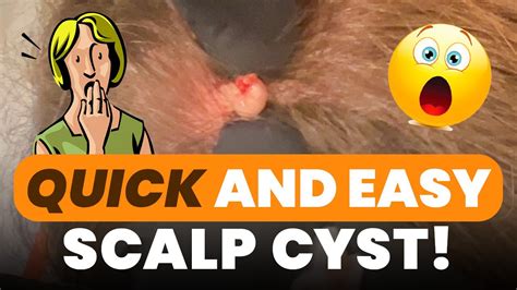 Quick And Easy Scalp Cyst Youtube