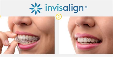 Invisalign Treatment Clear Aligners Carolina Smile Dentistry