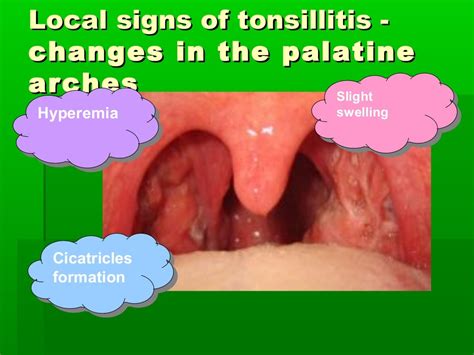 Tonsillitis Pathophysiology