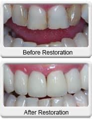 All-Ceramic Dental Crown - Ocotillo Dental Care | Chandler, AZ