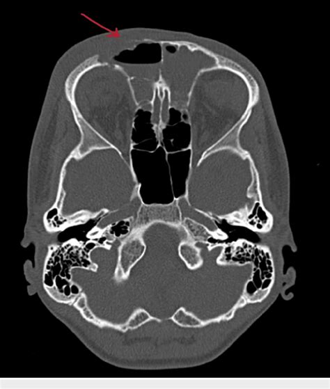 Figure 3 from Osteomyelitis of Frontal Sinus: A Rare Sequelae of Acute ...