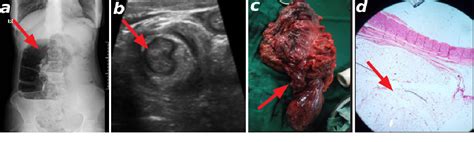 Figure From Adult Colocolic Intussusception And Lower