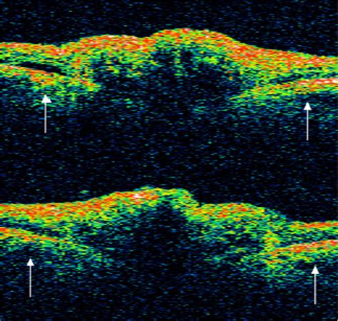 Stratus Oct Stratus Optical Coherence Tomography Carl Zeiss