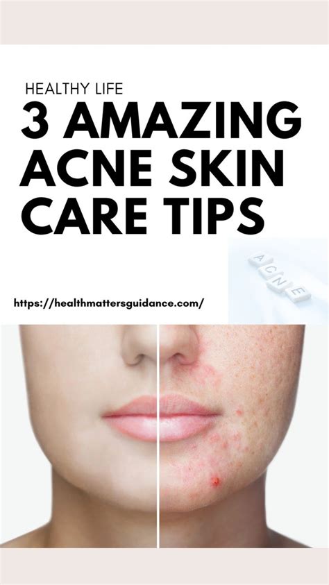 3 Amazing Acne Skin Care Tips Finally Get Beautiful Clear Skin Skin