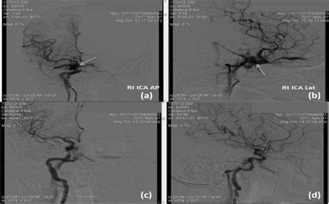 Cerebral Angiography A Anteroposterior Ap View B Lateral View