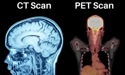 Choosing Your Diagnosis Pet Scan Vs Ct Scan Kiran Lab