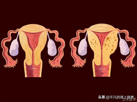 子宮內膜增厚，會不會得癌？關鍵要看月經 每日頭條