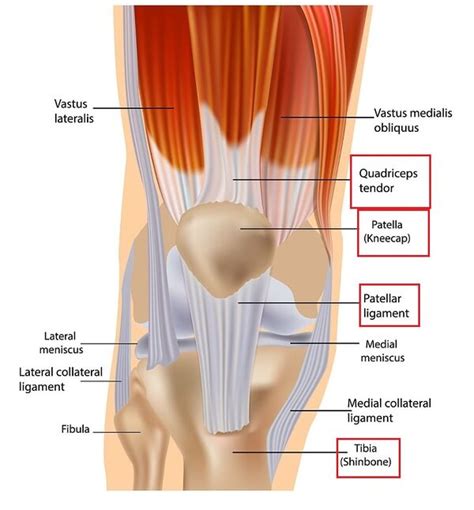 Patellar Tendonitis WikiSM Sports Medicine Wiki