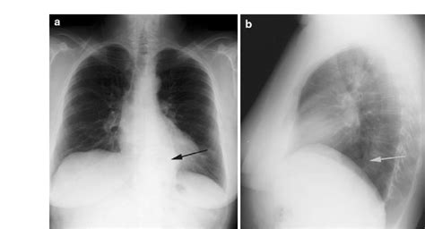 A Pa View Of A Hiatal Hernia Arrow B Lateral View Of A Hiatal Hernia