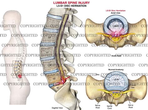 L5 S1 Lumbar Spine Disc Herniation Female Medical Art Works