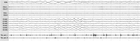 Typical Polysomnographic Finding Of The Excessive Fragmentary Myoclonus