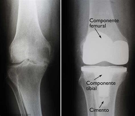 Artroplastia Total De Joelho Indicações Dr Márcio Silveira