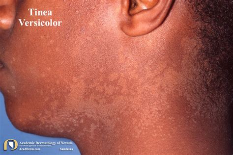 Tinea Versicolor Before And After