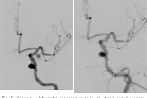 Figure 3 From A Case With Extracranial Carotid Artery Stenosis And