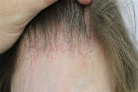 Causas de Pérdida de Cabello Tipos Alopecia MyCapil