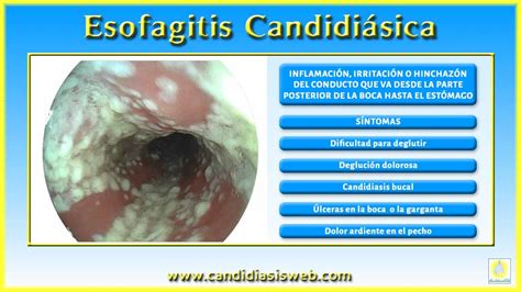 Subproducto Prestigioso Recibir Inflamacion Por Candida Redundante